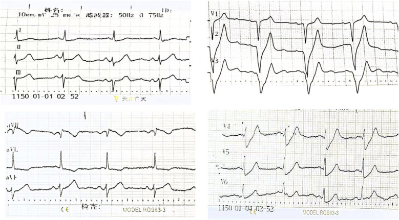 The dynamic evolution of the de Winter ECG pattern that is easily overlooked and life-threatening: a case report and literature review.
