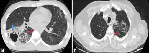 Tissue sample taken by transbronchial biopsy in the diagnosis of tuberculosis; benefits-risks.