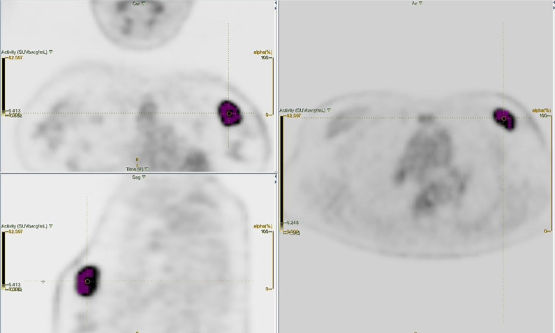 Relationship Between [<sup>18</sup>F]FDG PET/CT Texture Analysis and Progression-Free Survival in Patients Diagnosed With Invasive Breast Carcinoma.