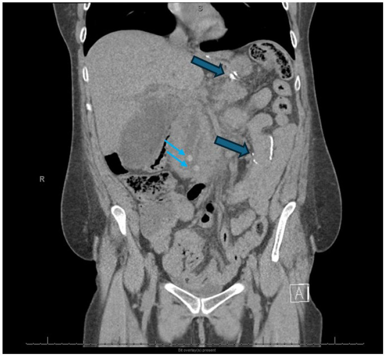 Interventional Management of Acute Pancreatitis and Its Complications.