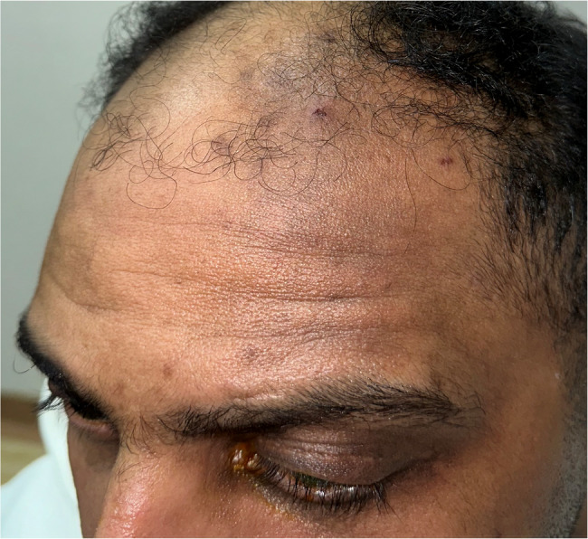 Post-corneal tattooing trigeminal nerve-distributed hyperpigmentation: a case report.