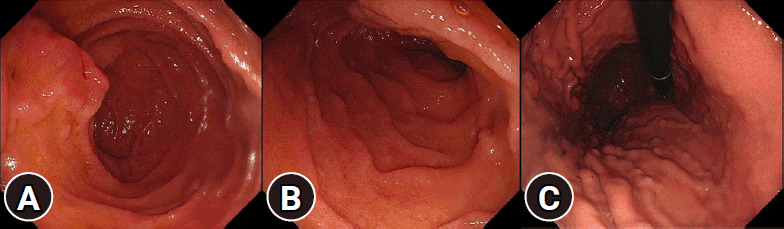 The polyp puzzle: multiple lesions, one diagnosis.
