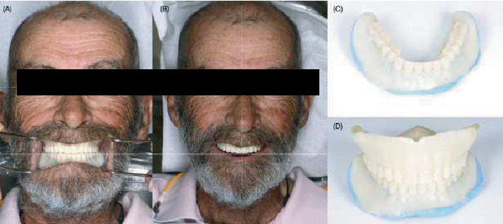 CAD-CAM Complete Dentures Manufactured Using Additive and Subtractive Manufacturing Techniques: A Feasible Clinical Approach for Managing Geriatric Patients With Advanced Residual Ridge Resorption.