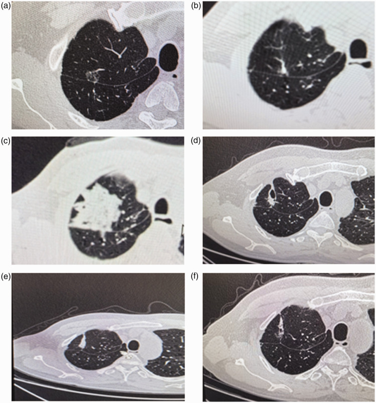 Safety and feasibility of computed tomography-guided radiofrequency ablation for treating high-risk pulmonary nodules in postoperative lung cancer patients.