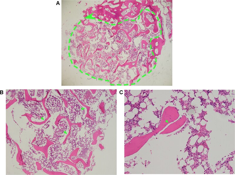 Chylothorax-induced diaphragmatic herniation: a novel complication of Gorham-Stout syndrome.