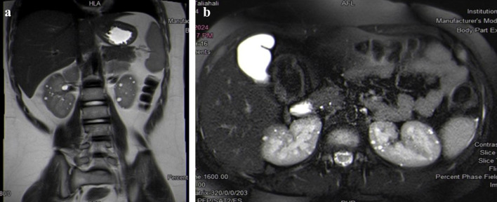 Renal Cell Carcinoma in a Girl With Tuberous Sclerosis Due to a New Mutation.