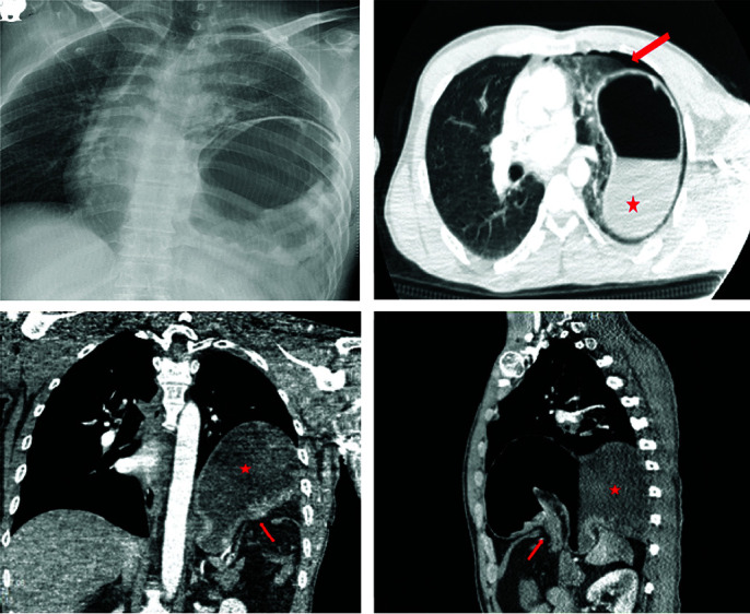 Minimally Invasive Treatment of Traumatic Diaphragm Rupture.