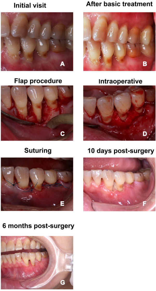 Incidence and risk factors of postoperative complications following periodontal flap surgery: a retrospective study.