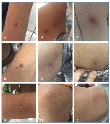 Unusual report of an immunocompetent patient with atypical cutaneous leishmaniasis caused by Leishmania (Leishmania) infantum in Minas Gerais, Brazil.