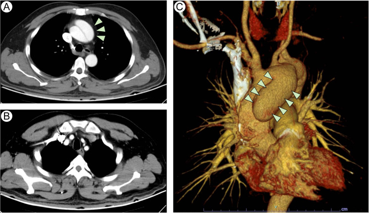 Aortic dissection disguised as musculoskeletal condition: a case report and review of literature.