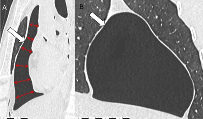 A rare complication of a thoracic wound: the pneumopericardium?