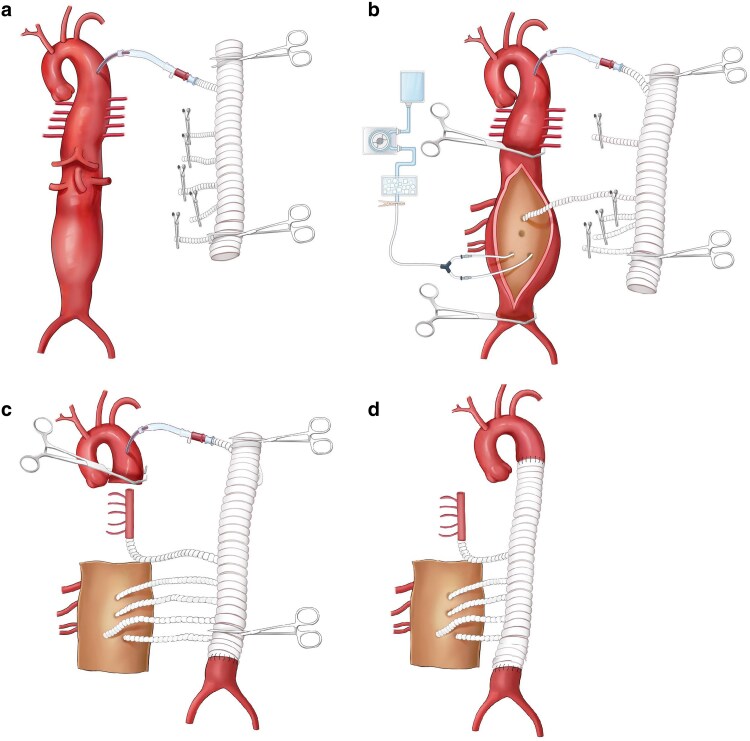 Evaluating normothermic artery bypass and visceral-anastomosis-first strategy in thoracoabdominal aortic aneurysm repair: propensity-weighted analysis.