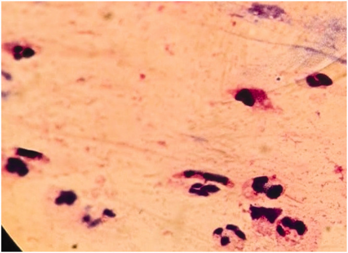 Shear wave elastography in the differentiation of intra-abdominal hematoma and abscess.