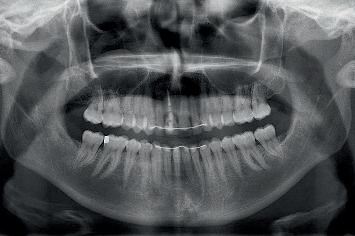 Fully Guided Implant Placement and Immediate Provisionalization in the Maxillary Aesthetic Zone Using Prefabricated Restorations.