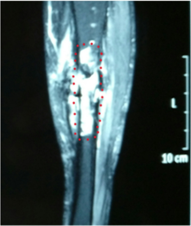 Study of the extent of surgical osteotomy in Cierny-Mader stages III and IV chronic osteomyelitis.