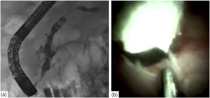 Long-Term Efficacy and Safety of Digital-Single-Operator-Video-Pancreatoscopy Guided Lithotripsy for Pancreatic Duct Stones.