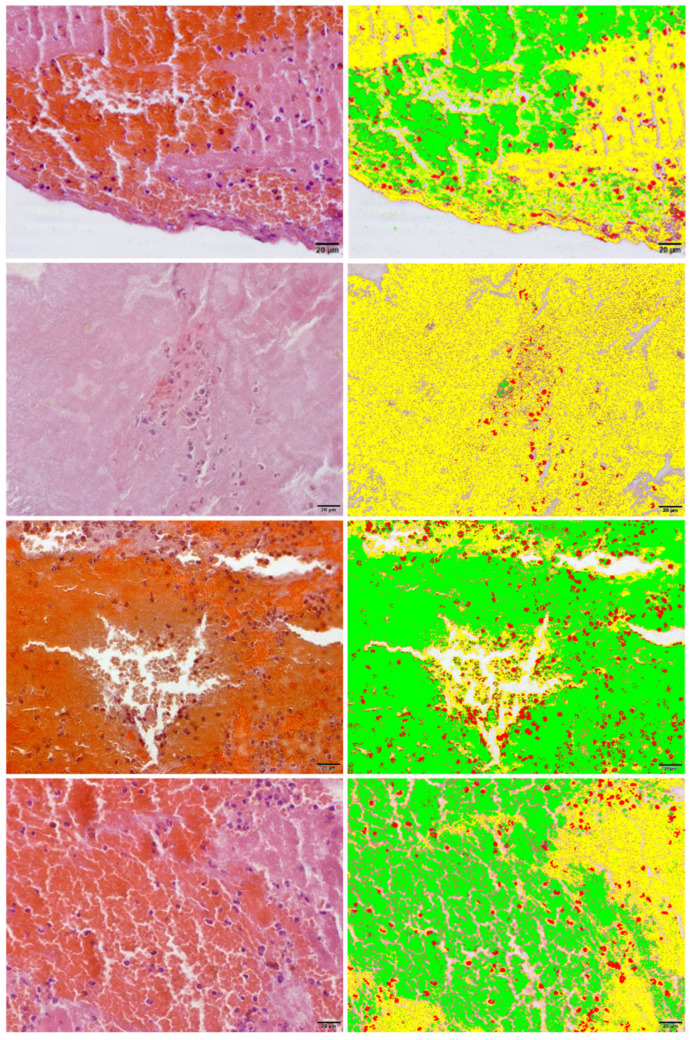 Optical and Scanning Electron Microscopy Thrombus Findings in Patients with STEMI Undergoing Primary Versus Rescue PCI.