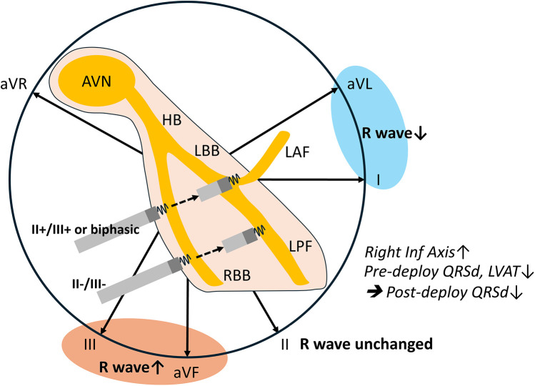 Role of peri-deployment right ventricular paced-ECG in left bundle area pacing.
