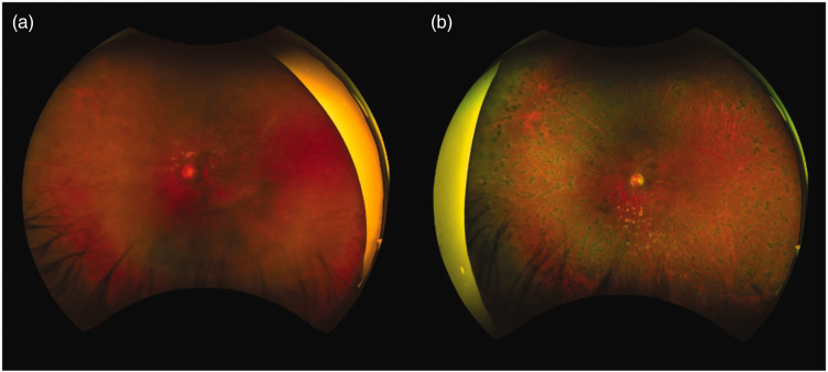 Neovascular glaucoma associated with central retinal vein occlusion in a young patient with hyperlipidemia.