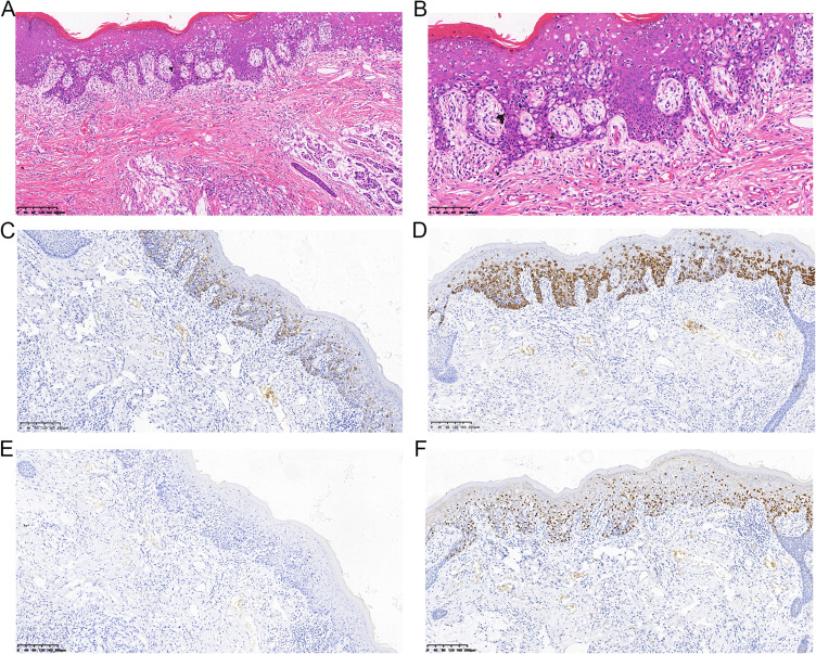 Secondary Perianal Paget's Disease Originating From Adenocarcinoma of the Anorectal Junction: A Case Report.