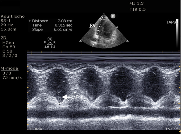 Right ventricular dysfunction: a key predictor of post-intubation hypotension in the emergency department.