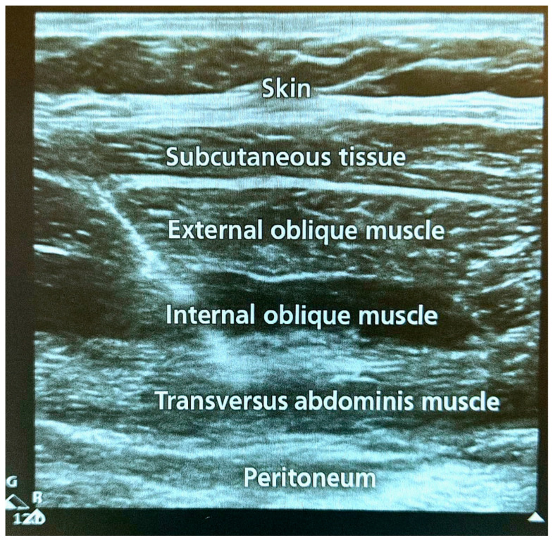 Ultrasound-Guided Regional Block in Renal Transplantation: Towards Personalized Pain Management.