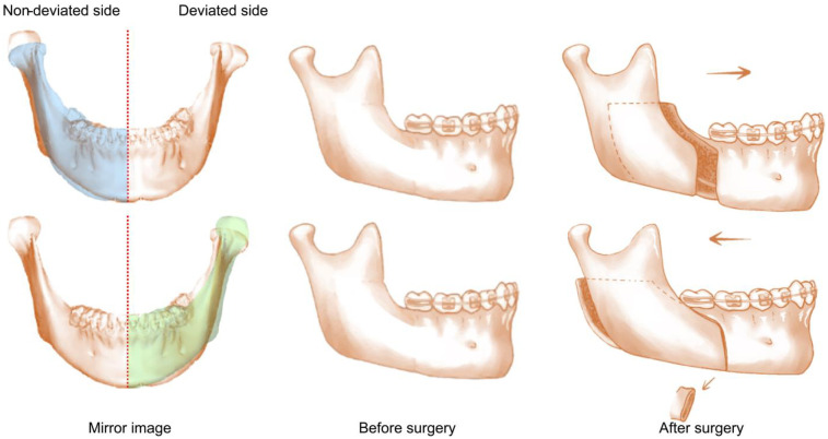 Machine learning-based assessment of condylar changes after orthognathic surgery of asymmetric dentofacial deformities.
