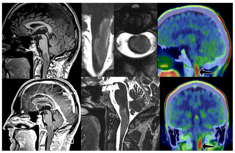 Brainstem Glioma Prognostication: Static FET PET/CT.