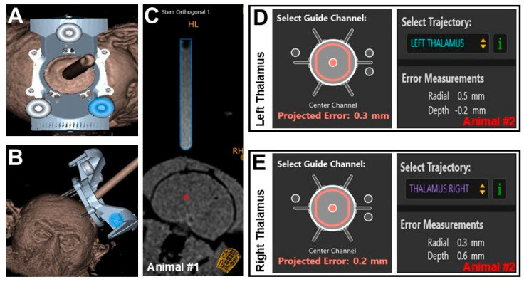 A Preliminary Study on the Accuracy of MRI-Guided Thalamic Infusion of AAV2-GFP and Biodistribution Analysis Using Cryo-Fluorescence Tomography in Nonhuman Primates.