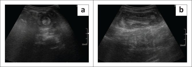 Risk factors associated with the outcomes of fluoroscopy guided pneumatic enema reductions of intussusceptions.