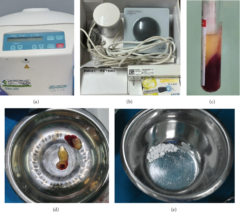 Combination of Platelet-Rich Fibrin and Carbonate Hydroxyapatite for Bone Regeneration in the Management of Radicular Cyst: A Case Report.