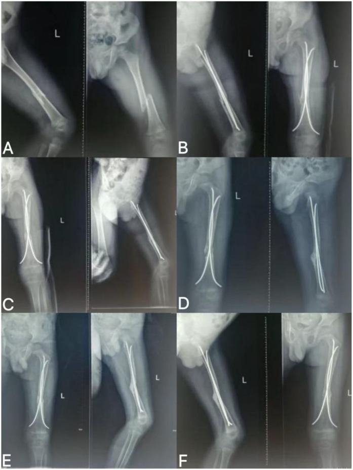Radial extracorporeal shock wave promotes the treatment of non-union of femoral shaft fractures in children: a case report.