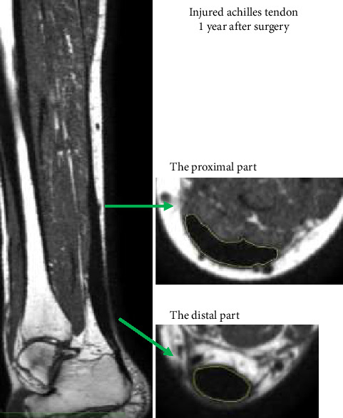 Morphological Changes One Year After Achilles Tendon Rupture Repair: A Comparison of Loading Strategies.