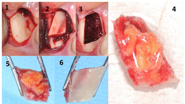Could Silent Inflammation Originating in Jawbone Cavitations Play a Role in Activating the CCL5/CCR5 Axis in Female Breast Cancer? A Diagnostic and Therapeutic Gap in Osteoimmunological Interactions.