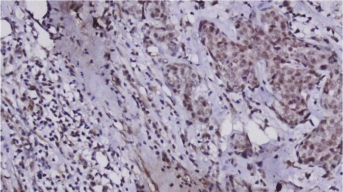 Evaluation of Tissue Expression of HMBG1 Protein in Patients With Breast Cancer.