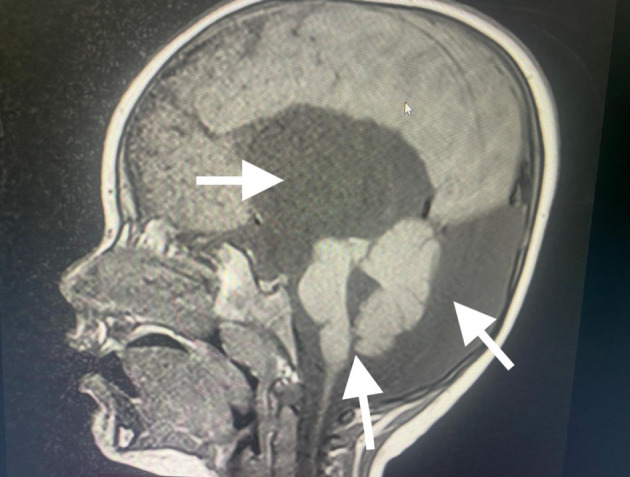 Anesthesiologist's Concerns About Dandy-Walker Syndrome: Airway Management, Muscle Relaxants, and Train-of-Four Monitoring of Neuromuscular Blockade.