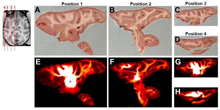 A Preliminary Study on the Accuracy of MRI-Guided Thalamic Infusion of AAV2-GFP and Biodistribution Analysis Using Cryo-Fluorescence Tomography in Nonhuman Primates.