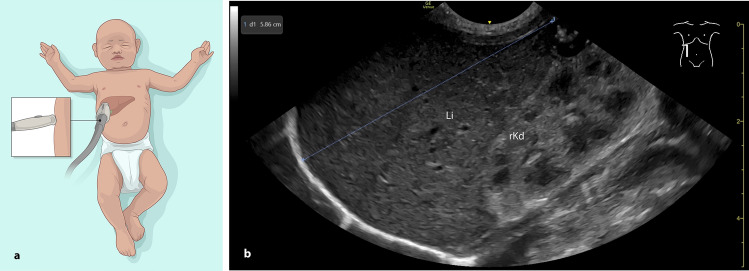 Turning the tide (and the probe)-sonographic liver measurement in the right lateral anterior axillary line is a reliable alternative to the standard frontal approach in term and preterm infants.