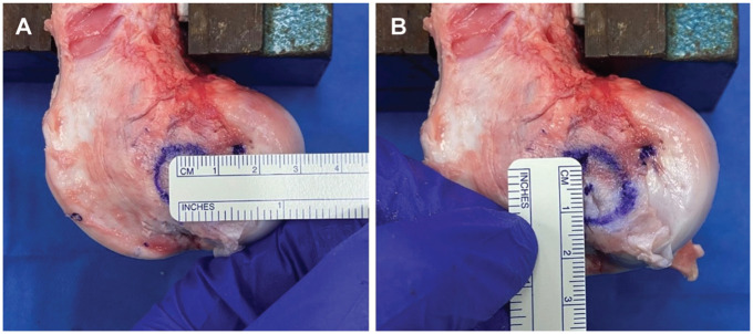 Onlay Fixation With an All-Suture Anchor Provides Sufficient Biomechanical Stability for Lateral Extra-articular Tenodesis.