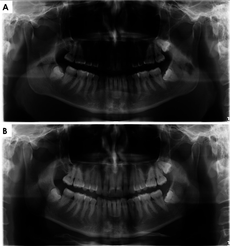 Reducing positioning errors in panoramic radiographs: Impact of an educational video on tongue positioning.
