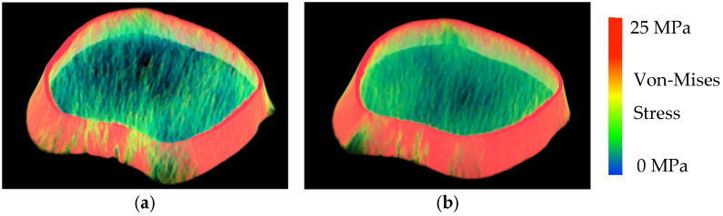 High-Intensity Physical Activity During Late Adolescence Predicts Young Adult CT-Based Finite Element Bone Strength in Emerging Adulthood: Iowa Bone Development Study.