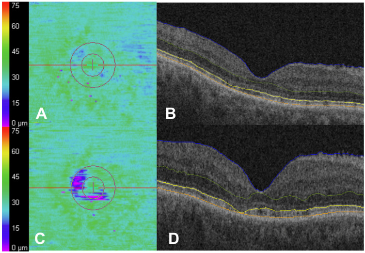 Longitudinal Ellipsoid Zone Dynamics During Hydroxychloroquine Use.