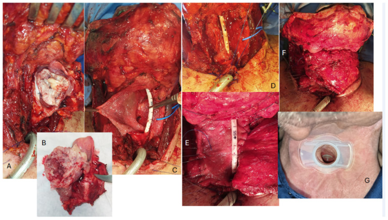 Safety of Primary Tracheoesophageal Puncture in Patients Submitted to Enlarged Total Laryngectomy with Pectoralis Major Reconstruction.