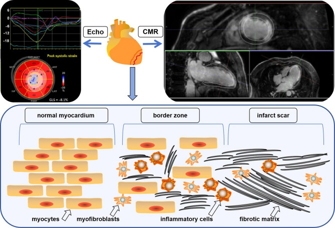 Imaging application in ventricular arrhythmia of ischemic cardiomyopathy: diagnosis, treatment and prognosis.