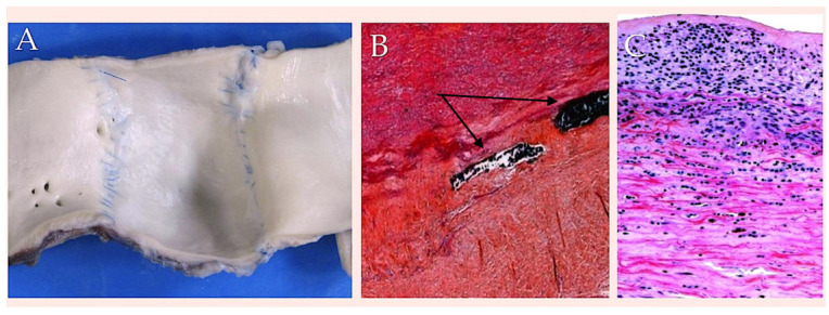 Suture Materials: Conventional and Stimulatory-Responsive Absorbable Polymers with Biomimetic Function.