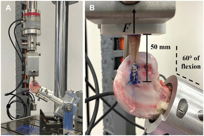 Onlay Fixation With an All-Suture Anchor Provides Sufficient Biomechanical Stability for Lateral Extra-articular Tenodesis.