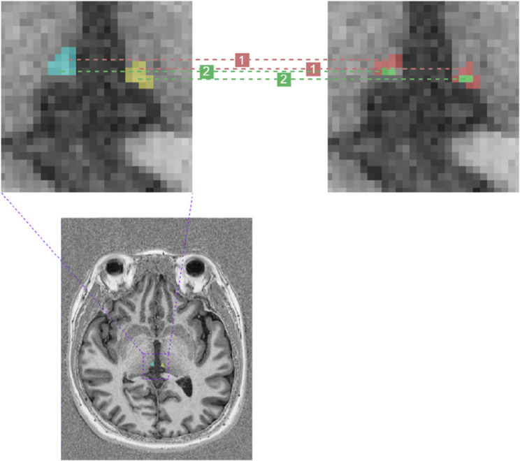 High-resolution structural magnetic resonance examination of the Habenula in patients with first-episode depression: an exploratory radiomics diagnostic value analysis based on cluster analysis.