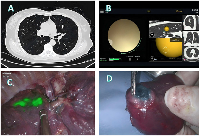 Robotic-assisted bronchoscopic localization for small pulmonary nodules: a novel approach to minimally invasive surgery.