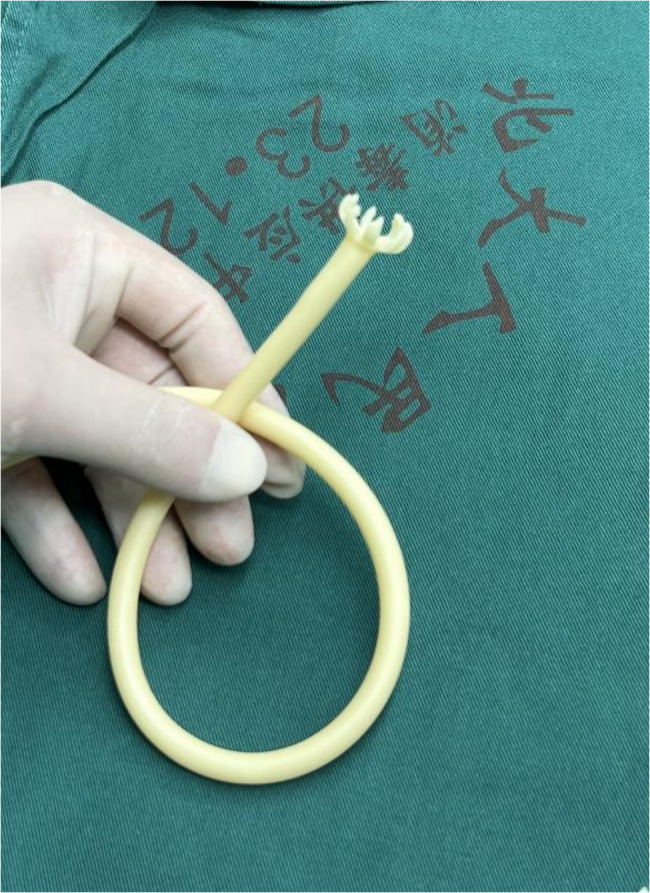 The submission title: management of retroperitoneal perforated descending duodenal diverticulum using de pezzer catheter drainage combined with nutritional jejunostomy: a case report and review of the literature.
