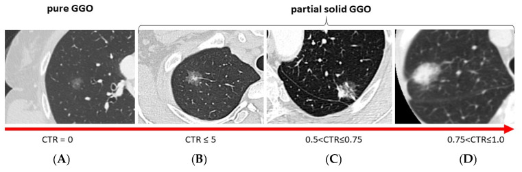 Clinicopathological Features and Prognosis of Lung Adenocarcinoma Presenting as Ground-Glass Opacity: A Single-Center Experience.